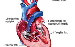 Những điều cần biết về bệnh tim bẩm sinh Tứ chứng Fallot