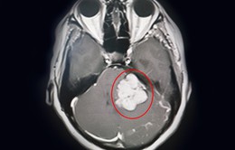 Phẫu thuật u góc tiểu não to như quả trứng cho ở vị trí khó