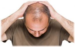 Phương pháp chữa trị bệnh hói đầu