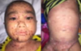 Mắc lupus ban đỏ: Bé trai 5 tuổi nổi bóng nước khắp người