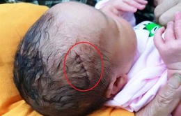Bé sơ sinh bị dao cắt rách da đầu