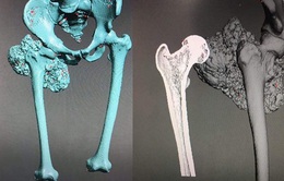 Lần đầu tiên bác sĩ Việt Nam ghép xương đùi nhân tạo in 3D