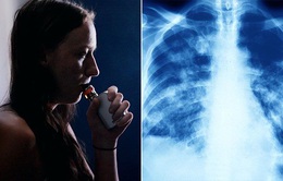 Thêm bằng chứng vitamin E Acetate gây tổn thương phổi ở người hút thuốc lá điện tử