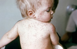 Hơn 140.000 người thiệt mạng vì bệnh sởi do không được tiêm vaccine