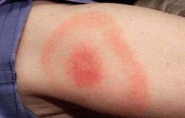 Vết quầng đỏ - dấu hiệu nhận biết của bệnh Lyme