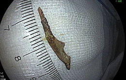 Mảnh xương dài 3cm "lẩn trốn" trong ruột thừa người đàn ông