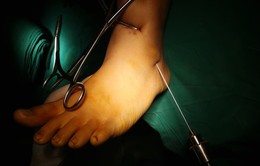 Điều trị chấn thương cẳng chân không cần mổ mở