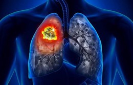 Hệ thống AI giúp phát hiện sớm ung thư phổi