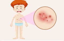 Điểm mặt các bệnh da liễu thường gặp vào mùa hè