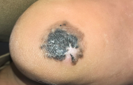 Từ một đốm đen nhỏ ở gan bàn chân, người đàn ông vào viện phát hiện ung thư da