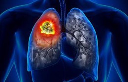 Xác định loại gen mở ra hy vọng cho bệnh nhân ung thư phổi