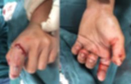 Nối ngón tay bị đứt lìa do cưa máy cắt cho thanh niên 18 tuổi