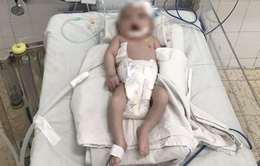 Bé gái sơ sinh bị teo thực quản hiếm gặp kèm biến chứng viêm phổi