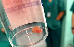 Hạt đậu phộng "cư trú" 2 tháng trong phổi bé gái, gây nhầm tưởng là hen suyễn
