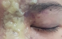 Thiếu nữ 15 tuổi mù mắt sau khi tiêm filler nâng mũi