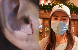 Người phụ nữ Trung Quốc bị mất một phần tai sau khi phẫu thuật mũi