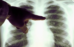 Ung thư phổi có thể bị chẩn đoán nhầm thành COVID-19
