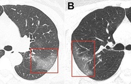 Phim chụp X-quang hé lộ tổn thương do nCoV ở phổi bệnh nhân