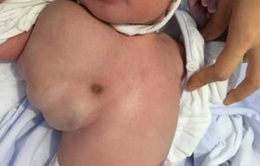 Cắt khối u 800gram ở bé sơ sinh 2 ngày tuổi