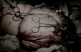 5 giờ phẫu thuật cắt u buồng trứng nặng gần 12kg ở bé gái 13 tuổi