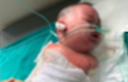 Nỗ lực cứu sống bé 9 tháng tuổi bị bỏng 45% diện tích cơ thể