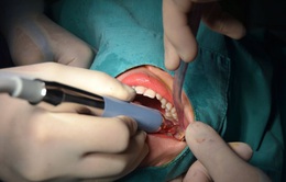 Áp xe vùng mặt - Hậu quả nặng nề khi chủ quan với biến chứng mọc răng khôn