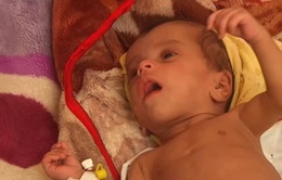 Dịch vụ y tế Yemen “không thể đối phó” với tình trạng trẻ em suy sinh dưỡng