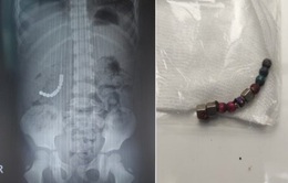 Phẫu thuật lấy 10 viên nam châm trong ruột bé 5 tuổi