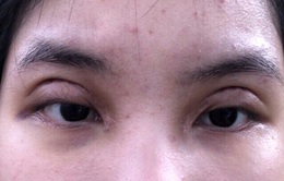 Cắt mí ở spa, nữ sinh viên 18 tuổi tại Hà Nội mất thị lực