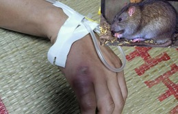 Nghi mắc dịch hạch sau khi bị chuột cắn vào tay