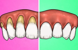 4 dấu hiệu cho thấy bạn đang đánh răng sai cách