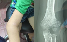Bé 6 tuổi cứng khớp, hạn chế vận động tay sau khi đắp thuốc nam chữa gãy xương