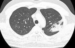 F0 bị nhẹ bất ngờ phát hiện nhiều tổn thương phổi hậu COVID-19