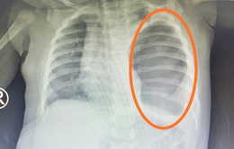 Nhập viện khám vì ngã võng, bé 4 tháng tuổi phát hiện thêm ruột và dạ dày chui lên lồng ngực