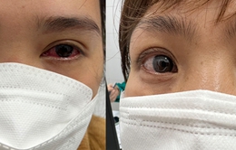 Cẩn trọng với những di chứng liên quan đến mắt hậu COVID-19