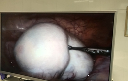 Phẫu thuật u buồng trứng lớn cho bé gái 13 tuổi