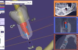 Safe-Tech: Công nghệ trồng răng Implant an toàn, không đau