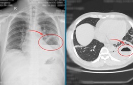 Phát hiện khối áp xe lớn trong phổi ở bệnh nhân COVID-19 tự điều trị  tại nhà