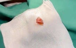 Ho ra máu gần 2 năm vì vỏ kẹo rơi vào phế quản