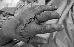 Nối lại ngón tay bị đứt lìa do tai nạn lao động cho nam bệnh nhân