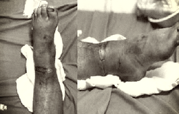 Vi phẫu nối bàn chân bị đứt lìa cho nam bệnh nhân 47 tuổi