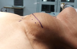 Phẫu thuật bướu giáp chiếm toàn bộ vùng cổ bệnh nhân