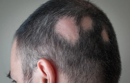Rụng tóc và rối loạn chức năng tình dục - triệu chứng COVID-19 kéo dài mới