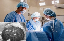 Cắt bỏ khối u buồng trứng bị hoại tử nặng khoảng 1kg cho bệnh nhân