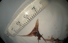 Nhập viện cấp cứu vì xương cá hình chữ Y cắm sâu vào thực quản