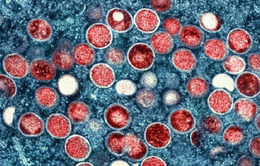 Dạng đậu mùa khỉ "khủng khiếp" ảnh hưởng đến người nhiễm HIV giai đoạn cuối