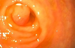 Cắt polyp tại ruột thừa hiếm gặp cho một bệnh nhi