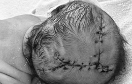 Khâu 21 mũi cho trẻ sơ sinh bị lóc da đầu sau khi sinh tại nhà