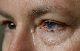 Cấy ghép tế bào gốc chữa tổn thương ở mắt tại Mỹ