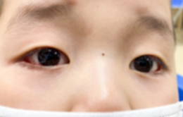 Gia tăng số trẻ mắc bệnh đau mắt đỏ